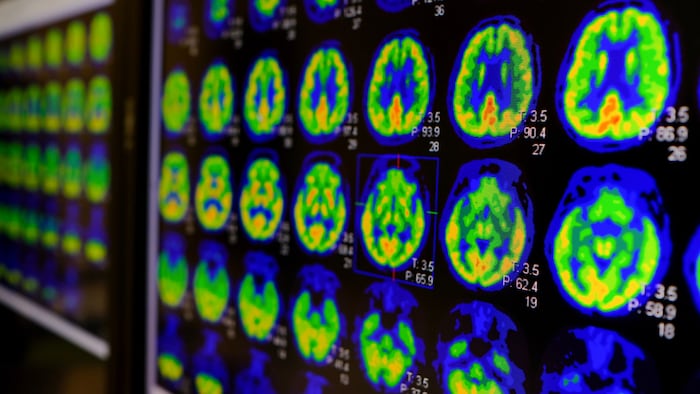 PET CT scan of Human Brain (Axial view Positron Emission Tomography)